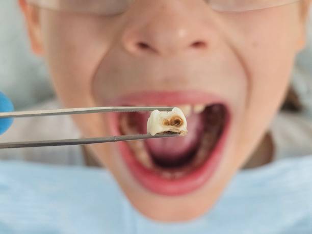 Best Chipped Tooth Repair Near Me  in Lakeside, FL
